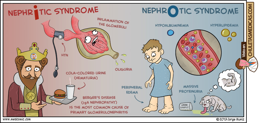 Diferencias entre Síndrome Nefrítico y Síndrome Nefrótico chuleta