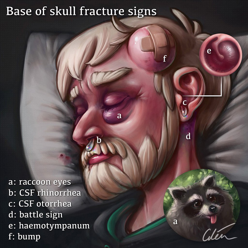 Signos de fractura de la base de cráneo artibiotics cilein
