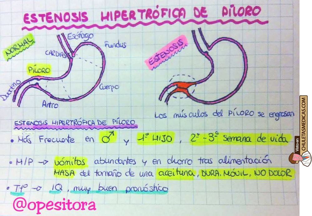 ¿Qué es la Estenosis Hipertrófica del Píloro? chuleta