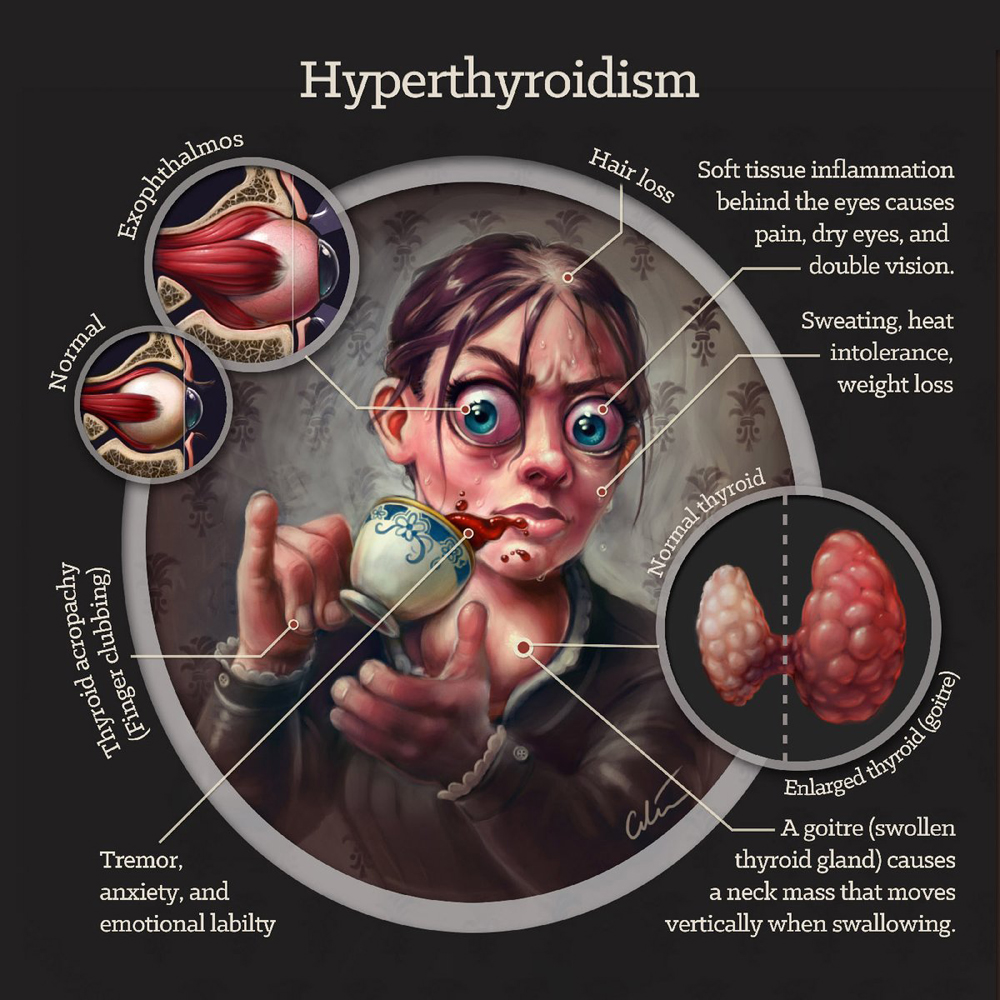 Hipertiroidismo: Signos clínicos artibiotics cilein chuleta