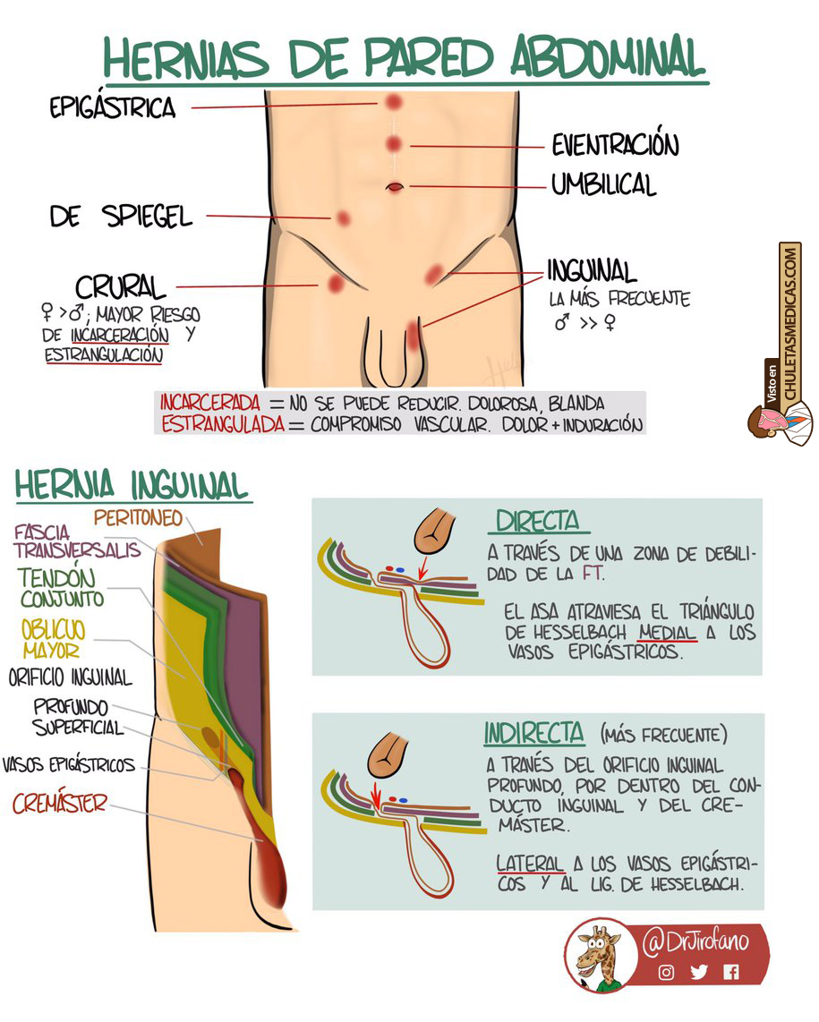 Hernias de la Pared Abdominal: Concepto y clasificación